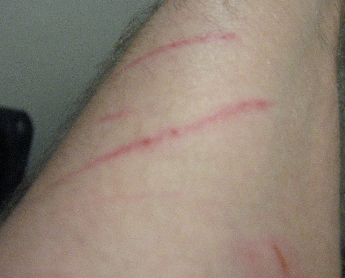 scratched arm The Life and Times of Bunnies